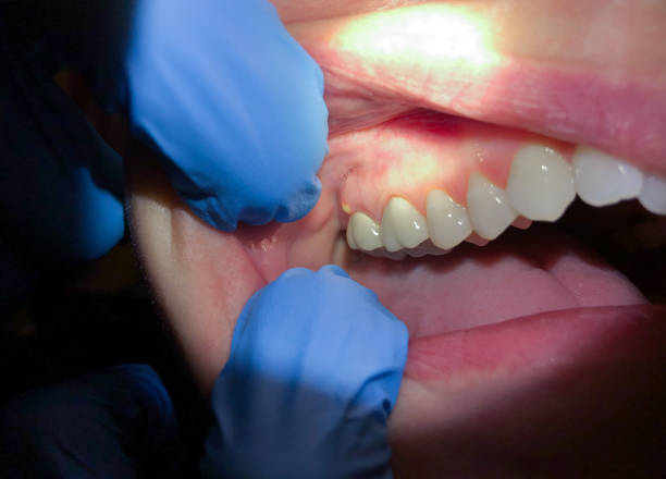 Best Emergency Tooth Extraction in Morris, MN