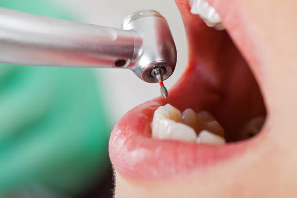 Best Emergency Treatment for Dental Infections or Abscesses in Morris, MN